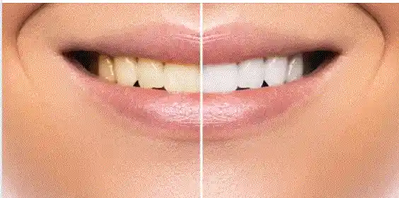 Home Remedies Teeth Whitening Tips..